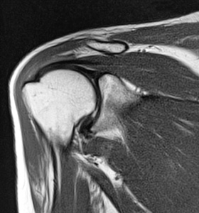 Conditions_MRI-shoulder